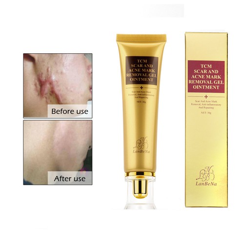 Stretch Marks Remove Acne Scar Treatment Cream